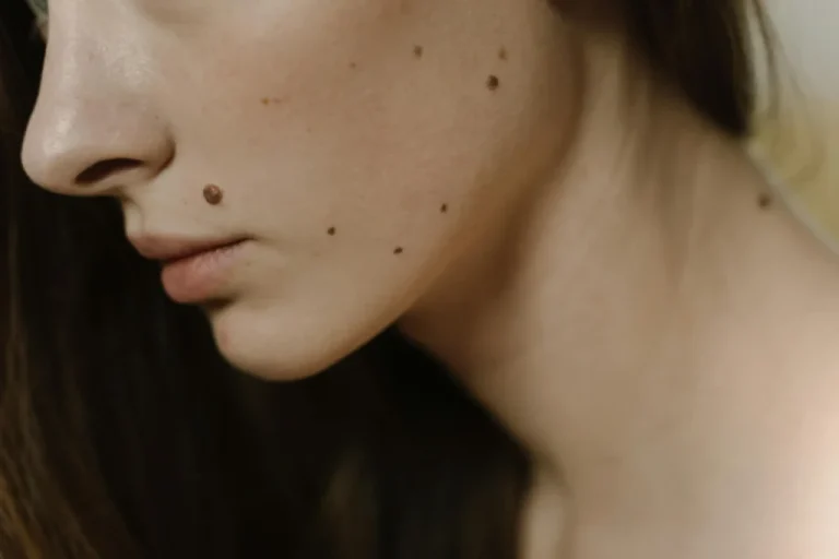 Od 12. do 14. lipnja obavite besplatan dermatološki pregled u Vukovarsko-srijemskoj županiji